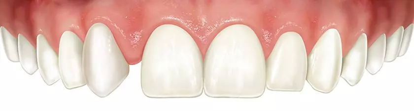 Agenesia: saiba quais são as causas dessa anomalia dentária