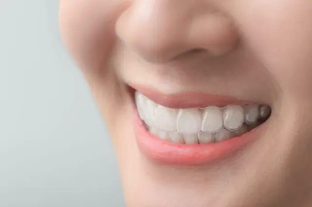 Imagem do artigo - Invisalign Perdizes: Sorriso Perfeito Sem Aparelho Metálico 